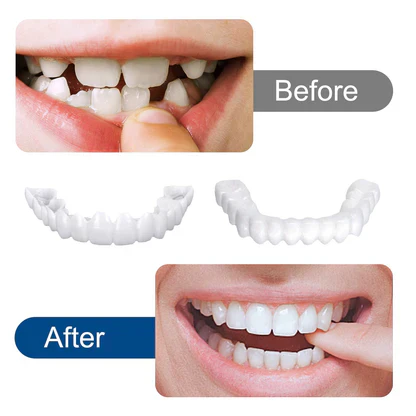 SnapOn Smile Dental Veneers